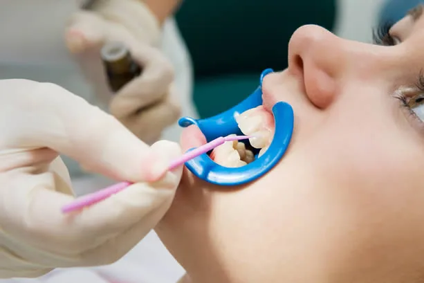 Dental sealants applied to teeth at Detroit Dentist