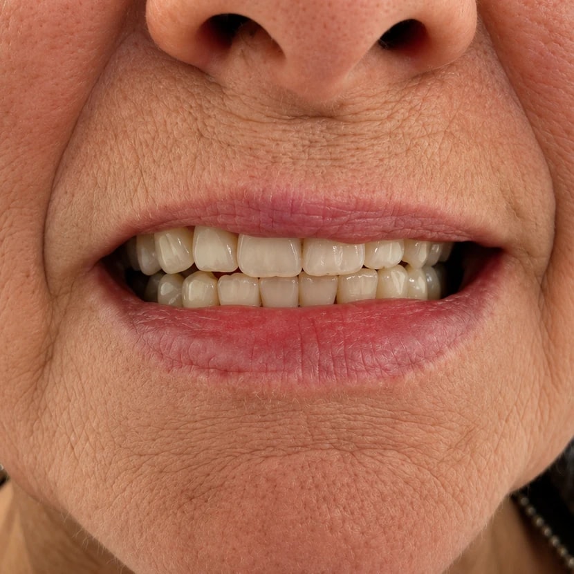 Case 2 All-on-4 / Full Arch — before treatment